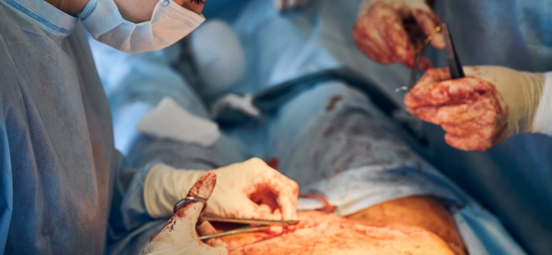 Doctor and assistant stitching up wound after abdominoplasty surgery. Doctors assisting stitching after hernia surgery